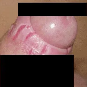 zapalenie napletka zdjęcie