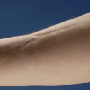 zapaleniem powięzi z eozynofilią