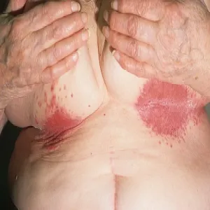 zdjęcia odparzeń pod piersiami
