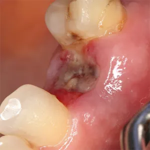 suchy zębodół foto