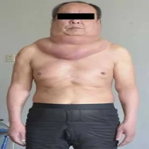 zespół Launois-Bensaude 