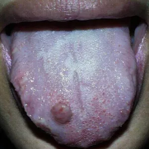 ziarniniak naczyniowy na języku