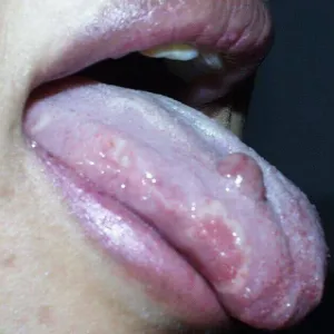 ziarniniak ropotwórczy na języku