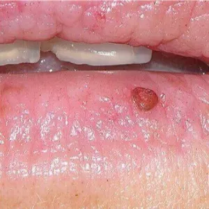 ziarniniak ropotwórczy na ustach