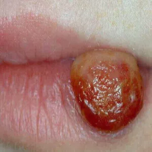 ziarniniak ropotwórczy 