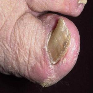 zmiany na paznokciach u nóg onychogryfoza