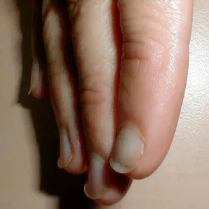 zmiany na paznokciach u rąk koilonychia