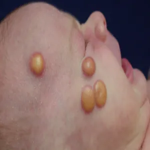 zmiany na skórze twarzy u niemowląt