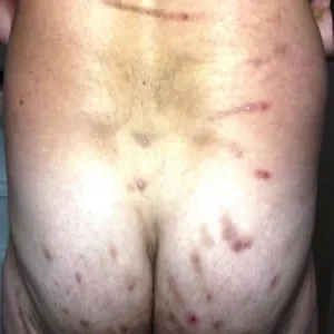 zmiany skórne na pośladkach przeczosy