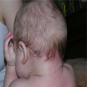 znamię uszczypnięcie bociana