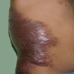 znamiona barwnikowe wypukłe