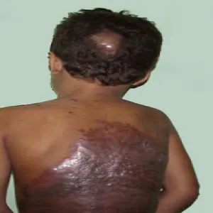 znamiona olbrzymie na plecach