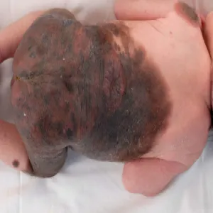 znamiona olbrzymie u dziecka