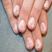 Białe przebarwienia na paznokciach