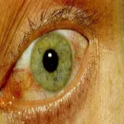 Choroba Behçeta objawy oczne