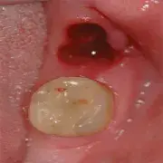 Jak wygląda skrzep po wyrwaniu zęba