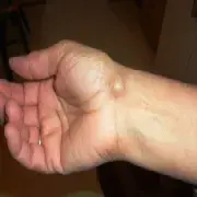 Włókniak twardy na dłoni