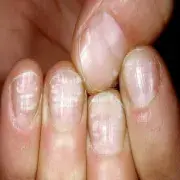 bielactwo paznokci 