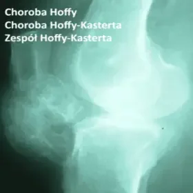 Choroba Hoffy, choroba Hoffy-Kasterta, zespół Hoffy-Kasterta 