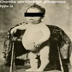 Choroba von Gierkego, glikogenoza typu Ia