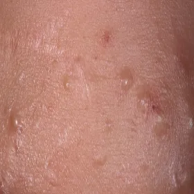 Łagodne zmiany skórne zaskórniki zamknięte