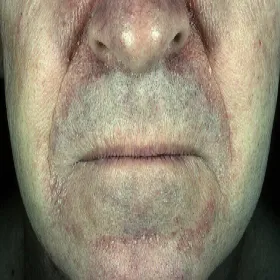 Łojotokowe zapalenie skóry objawy