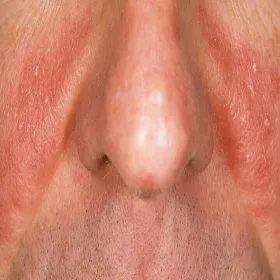 Łojotokowe zapalenie skóry twarzy