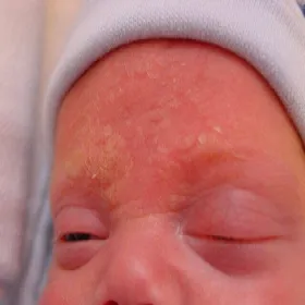 Łojotokowe zapalenie skóry u dzieci grzyb Pityrosporum ovale (Malassezia furfur)