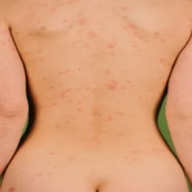 Łupież różowy Giberta na plecach