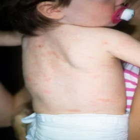 Łupież różowy Giberta wysypka u dziecka