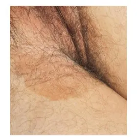 Łupież rumieniowy zdjęcie