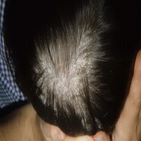 Łuszcząca się skóra głowy u dziecka