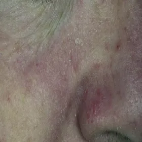 Łuszcząca się skóra koło nosa 