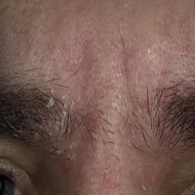 Łuszcząca się skóra między oczami 