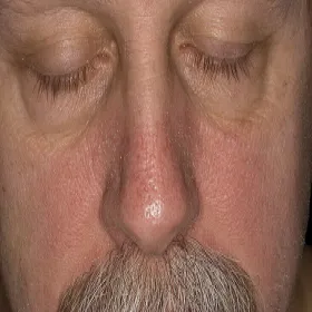 Łuszcząca się skóra na twarzy u mężczyzny 