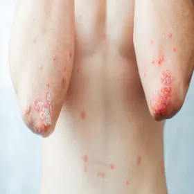 Łuszczyca na łokciach