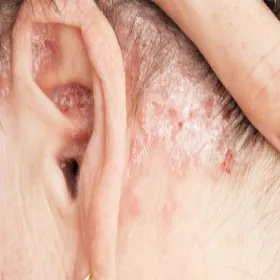 Łuszczyca na głowie