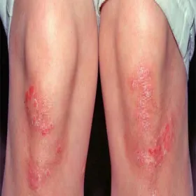 Łuszczyca na kolanach