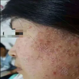 Łuszczyca na twarzy