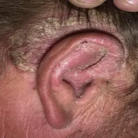 Łuszczyca za uchem
