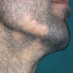 Łyse placki na brodzie