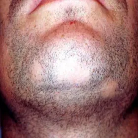 Łysiejące miejsce na brodzie łysienie plackowate