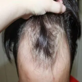 Łysienie androgenowe typu męskiego choroba