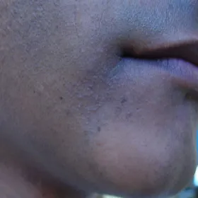 Łysienie plackowate obejmujące okolicę brody