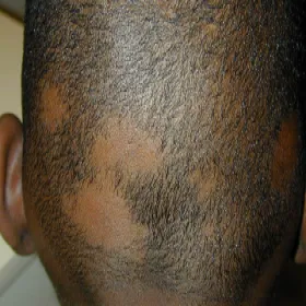 Łysienie plackowate objawy