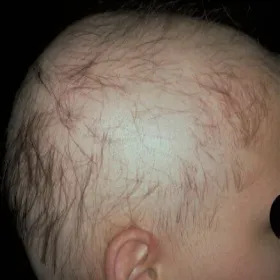 Łysienie plackowate u dzieci