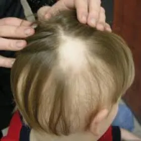 Łysienie u dzieci łysienie plackowate