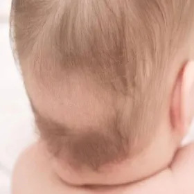 Łysy placek na głowie u niemowlaka