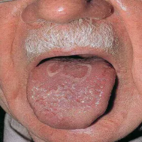 łagodne wędrujące zapalenie języka