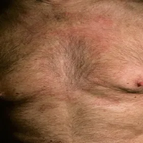 łojotokowe zapalenie skóry klatka piersiowa